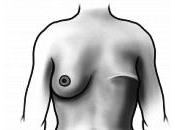 Things Remember Following Mastectomy