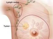 What About Mastectomy Surgery Reconstruction