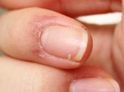 Amazing Home Remedies Peeling Fingertips