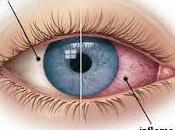 That Need Know About Pink (Conjunctivitis)