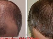 Side Effects Hair Transplantation Surgery Long Term