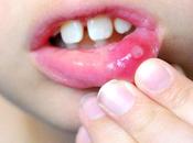 Home Remedies Mouth Ulcers