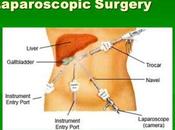 Laparoscopic Surgery Facts: What Expect?