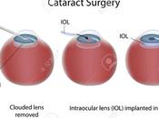 Cataract Surgery Safe Effective?