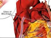 Coronary Bypass Surgery What Expect?