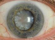 Eye-drops Melt Away Cataracts