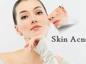 Easy Aromatherapy Oils Acne Treatment