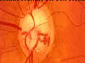 #HealingGlaucoma Book Review Must Read Heal Glaucoma Natural
