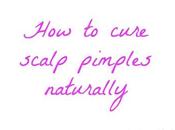 Cure Scalp Pimples Naturally?