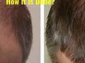 What Hair Grafting Done Advantages