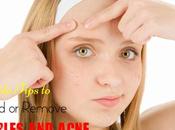 Simple Tips Avoid Remove Pimples Acne