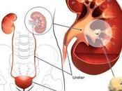 Natural Ayurvedic Home Remedies Kidney Stone