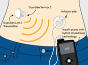 Revolutionary “Artificial Pancreas” Treatment Type Diabetes