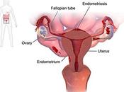 Natural Cure Endometriosis