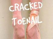 Cracked Toenail