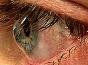 Ayurvedic Treatment Keratoconus