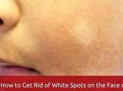 White Spots Face Babies Kids?