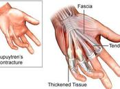 Friday Q&amp;A: Dupuytren's Contracture