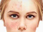Keto Low-Carb Diets Cure Acne?