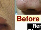 Best Home Remedy Remove Blackheads Whiteheads