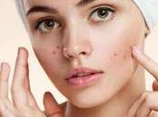 Most Common Acne Problems Treatments Must Knowing!