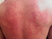 Natural Treatment Idiopathic Thrombocytopenic Purpura