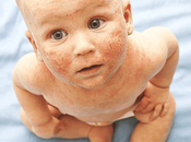 Eczema Babies Causes, Prevention Treatment
