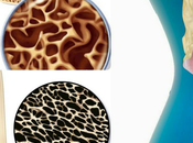 Management Osteoporosis Ayurveda Natural Treatment