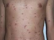 Kill: Facts About Chickenpox