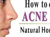 Acne Scars Fast? Natural Home Remedies
