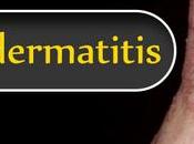 Treat Neurodermatitis Ayurveda