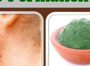 Neem Help Cure Acne Permanently?