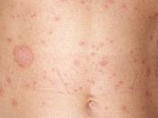 What Pityriasis? Know More About It's Treatment