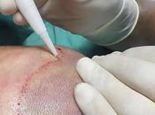 Hair Transplantation with Technique