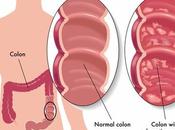 Ayurveda Heals Ulcerative Colitis Naturally