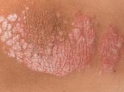 Natural Treatment Psoriasis