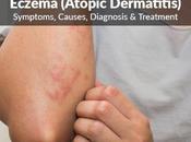 (Eczema) Symptoms Treatment Causes Eczema