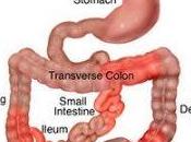 Crohn's Disease Best Tips Symptoms Causes