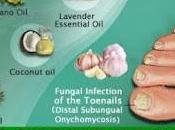 Toenail Fungus Home Remedies