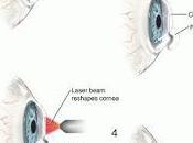 Best Lasik Surgery Presbyopia