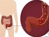 Best Alternative Treatment Mesacol Suppository