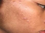 Oily Skin This Summer? DE-GREASE Face Wash