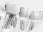 Zirconia Implants Essentials Need Know About