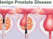 Ayurvedic Panchakarma Treatment Benign Prostatic Hyperplasia
