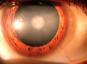 Cataract Causes, Symptoms Treatment