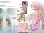 Causes Sarcoidosis Treated with Ayurveda