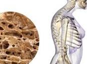 Treatment Osteoporosis with Food Supplements