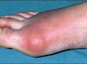 Herbal Remedies Reduce High Levels Uric Acid