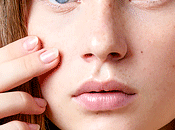 Easy Quick Acne Home Remedies