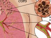 Chronic Obstructive Pulmonary Disease (COPD) Treatment Ayurveda